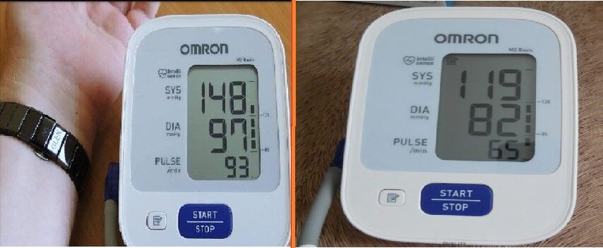 Tanometerwerte vor und nach der Einnahme von Cardione